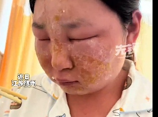 女子洗手频繁导致过敏脸变形,丈夫回应 女子洗手频繁导致过敏脸变形,丈夫回应