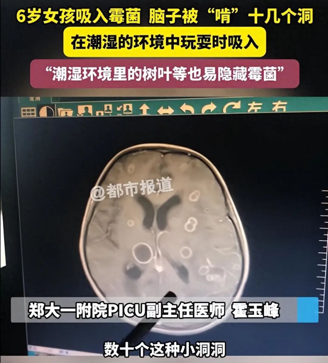家长必看！6岁女童脑内现十余洞，竟是家中的它在“作祟”→