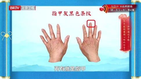 手掌出现这种褶皱，要关注自己的心脏