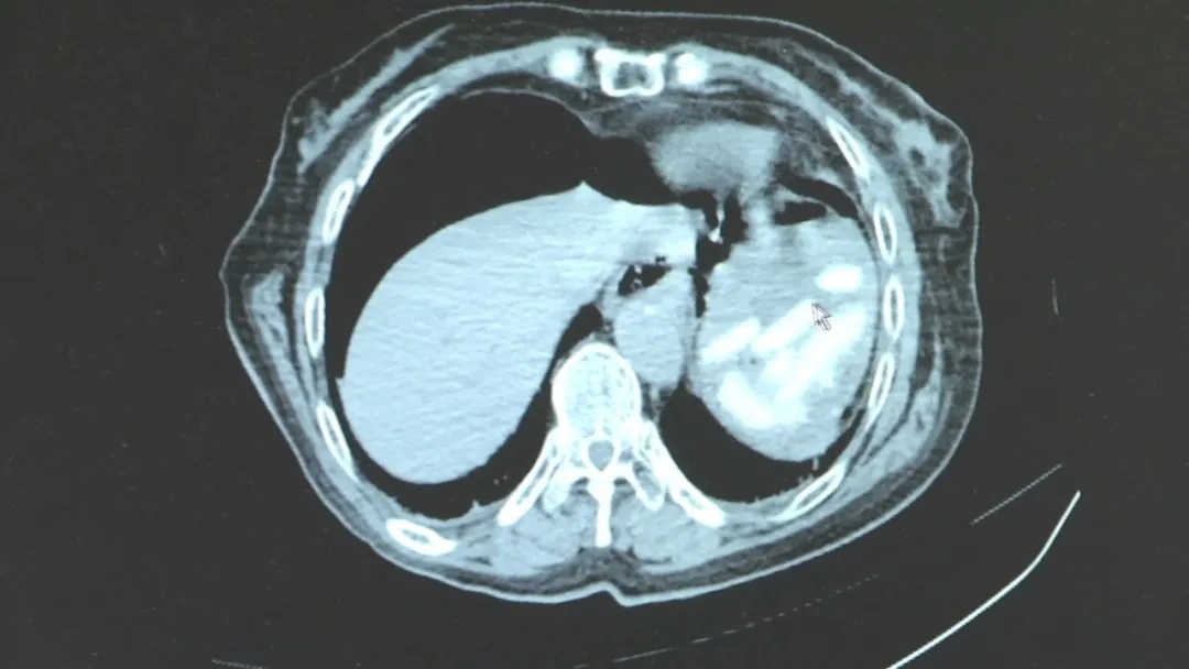 73岁老人吃年糕卡喉，家属施救操作不当致其胃部撕裂，医生提醒海姆立克急救法注意事项