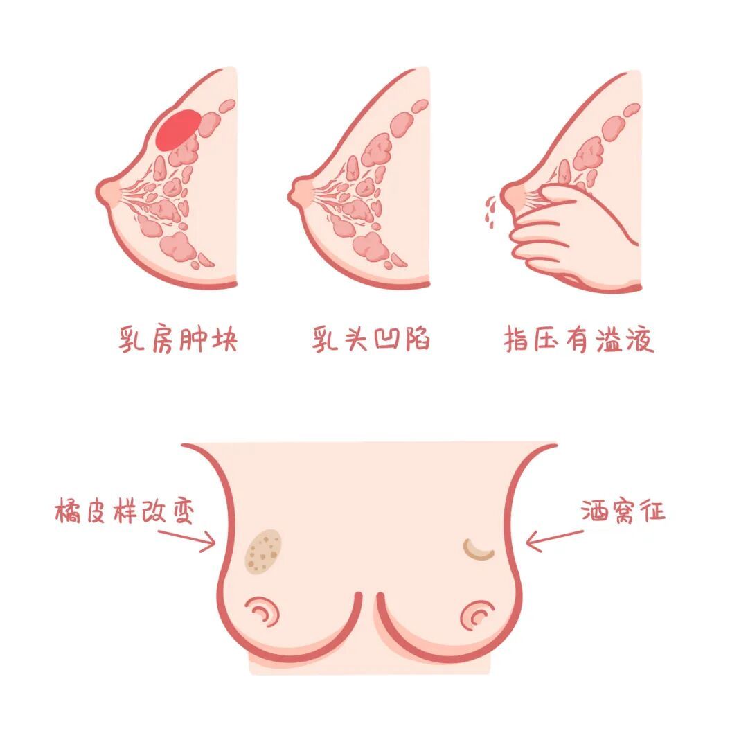 乳腺报告“异常”别焦虑！这可能是身体在和你“撒娇”