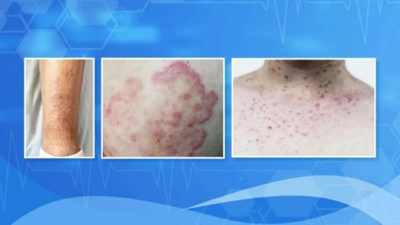 从身上痒到癌症晚期,仅90天!这几种瘙痒别当成小事 从身上痒到癌症晚期,仅90天!这几种瘙痒别当成小事