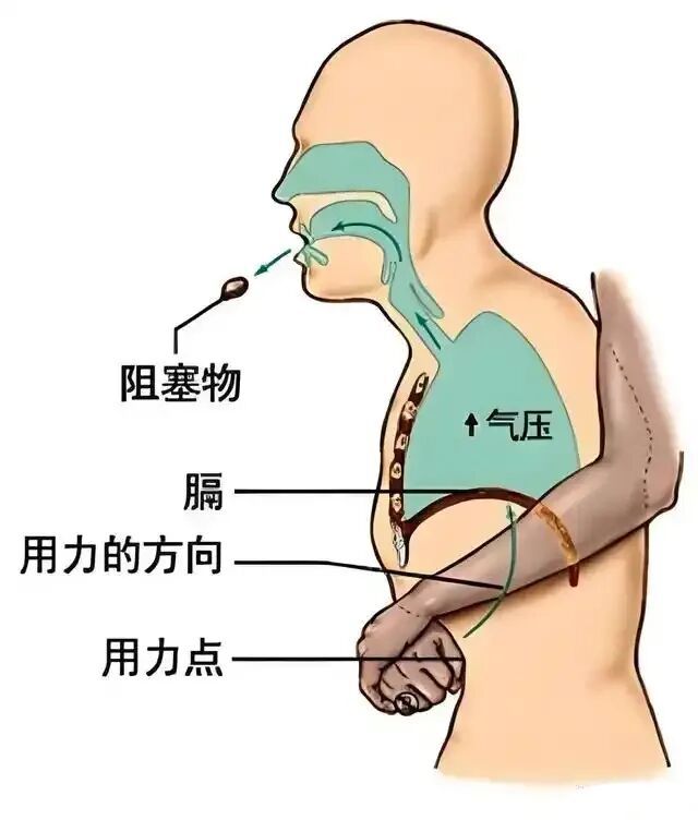 73岁老人吃年糕卡喉，家属施救操作不当致其胃部撕裂，医生紧急提醒
