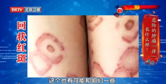 从身上痒到癌症晚期,仅90天!这几种瘙痒别当成小事 从身上痒到癌症晚期,仅90天!这几种瘙痒别当成小事