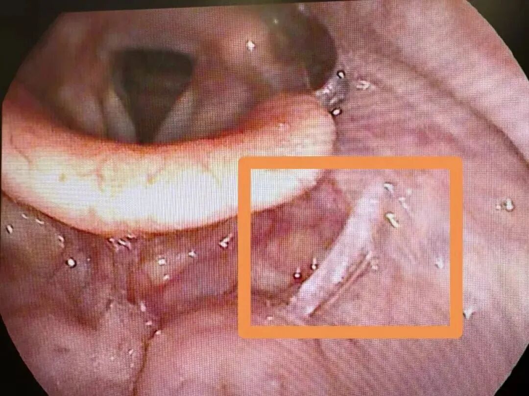 一碗汤泡饭下肚，浙江4岁男孩被妈妈抱着冲进急诊！千万要注意……