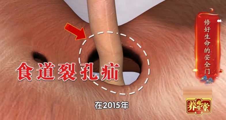 反酸、烧心,当心是这个睡姿“躺”出来的!等到胃“消失”就晚了…… 反酸、烧心,当心是这个睡姿“躺”出来的!等到胃“消失”就晚了……