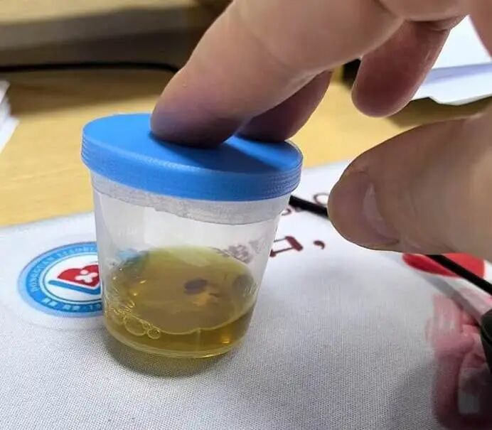 头皮发麻！男子胆管爬满密密麻麻的虫……曾在半年前吃过这道美味，很多人都爱吃