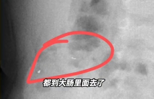 1岁宝宝半夜发出咀嚼声，竟把金锁嚼碎吞了！妈妈吓懵：真“吞金兽”