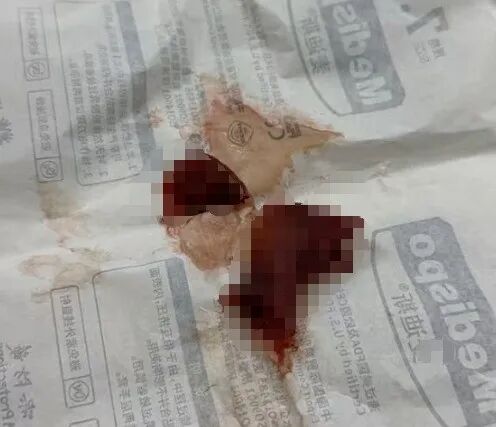 儿童气道异物险夺命!连续两例!医生紧急提醒 儿童气道异物险夺命!连续两例!医生紧急提醒