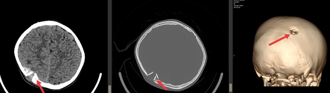 男童模仿特技摔伤颅骨!专家提醒:警惕迟发性损伤 男童模仿特技摔伤颅骨!专家提醒:警惕迟发性损伤
