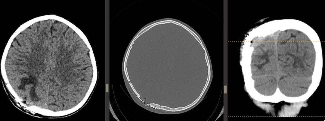 男童模仿特技摔伤颅骨!专家提醒:警惕迟发性损伤 男童模仿特技摔伤颅骨!专家提醒:警惕迟发性损伤