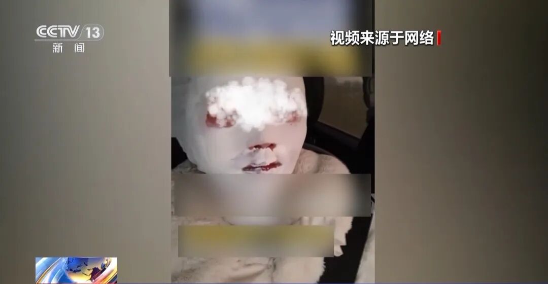 高压锅突然爆炸!女子面部、颈部被烫伤…… 高压锅突然爆炸!女子面部、颈部被烫伤……