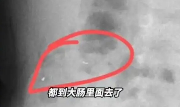 1岁多宝宝把金锁嚼碎吞了 拍片后无大碍 妈妈笑称生了个“吞金兽”