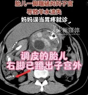 惊险！胎儿“无影脚”蹬出子宫外，医生用时18分钟托住两条命