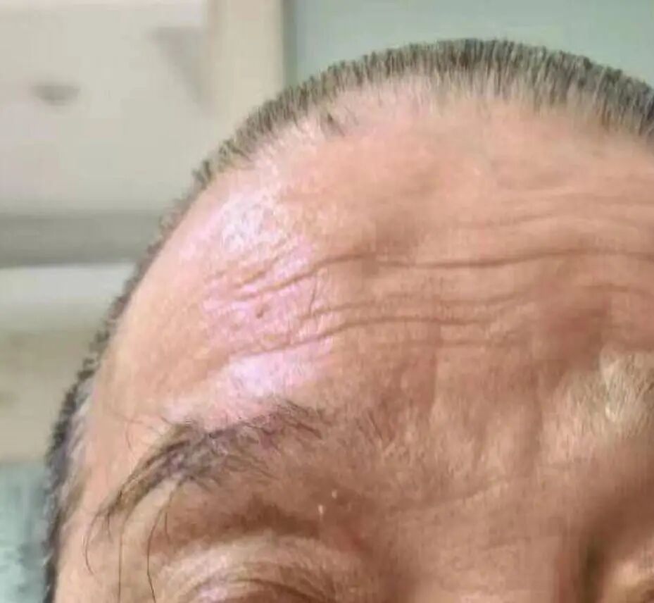 半边额头突发大片红疹,竟是“天下第一痛” 半边额头突发大片红疹,竟是“天下第一痛”