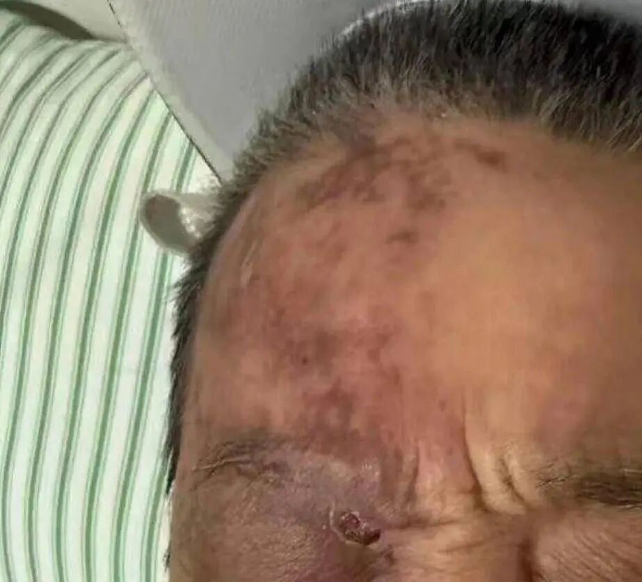 半边额头突发大片红疹,竟是“天下第一痛” 半边额头突发大片红疹,竟是“天下第一痛”