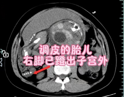 女子孕晚期腹痛不止，竟是被胎儿踢破子宫，破裂口被孩子的腿卡住了