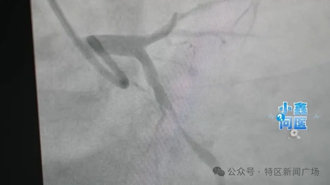 厦门28岁小伙突发心梗！医生：血管堵得一塌糊涂
