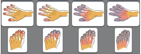 寒潮来袭警惕冻伤 手指发麻发痒别忽视