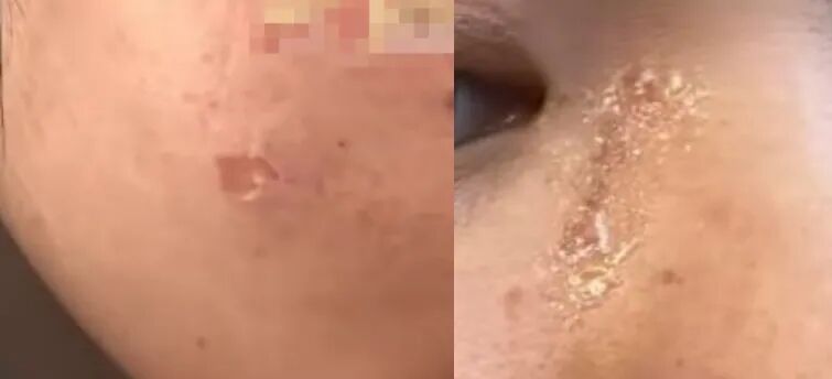 女子焚烧垃圾突遇爆炸，脸部被烫伤！现场画面曝光