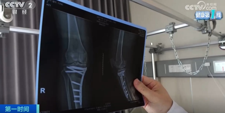 关节肿痛、手指僵硬？小心患上头号致残性疾病！这些地方疼别硬抗↓