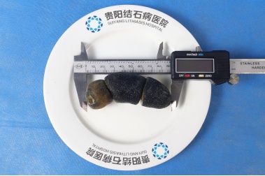 贵阳一患者体内取出“巨无霸”胆结石，这些生活习惯是“帮凶“，春节期间尤其要注意