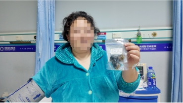 贵阳一患者体内取出“巨无霸”胆结石，这些生活习惯是“帮凶“，春节期间尤其要注意