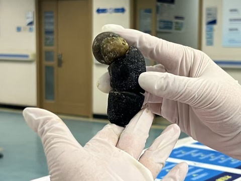 贵阳一患者体内取出“巨无霸”胆结石，这些生活习惯是“帮凶“，春节期间尤其要注意