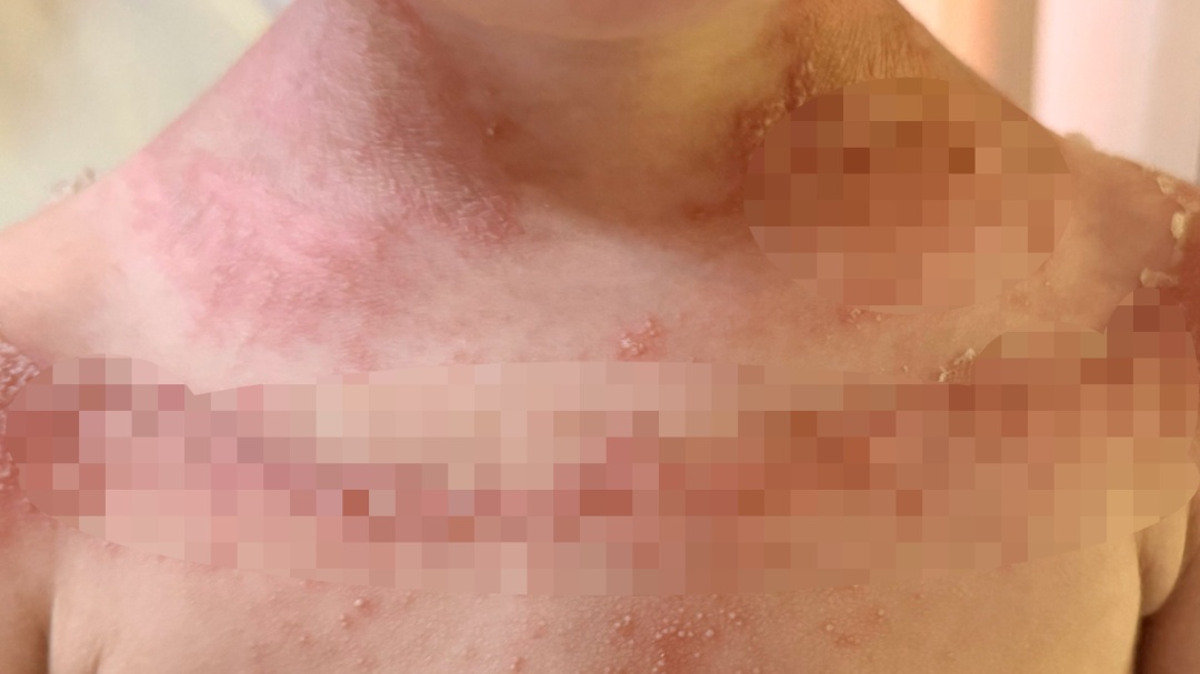 “仿佛是僵尸”！浙江两家人接连中招，大人小孩皮肤“报废”！元凶藏在家中角落