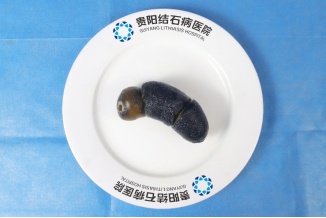 贵阳一患者体内取出“巨无霸”胆结石，这些生活习惯是“帮凶“，春节期间尤其要注意