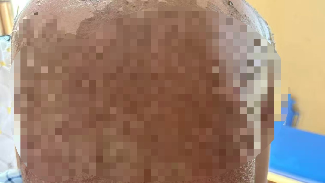 “仿佛是僵尸”！浙江两家人接连中招，大人小孩皮肤“报废”！元凶藏在家中角落