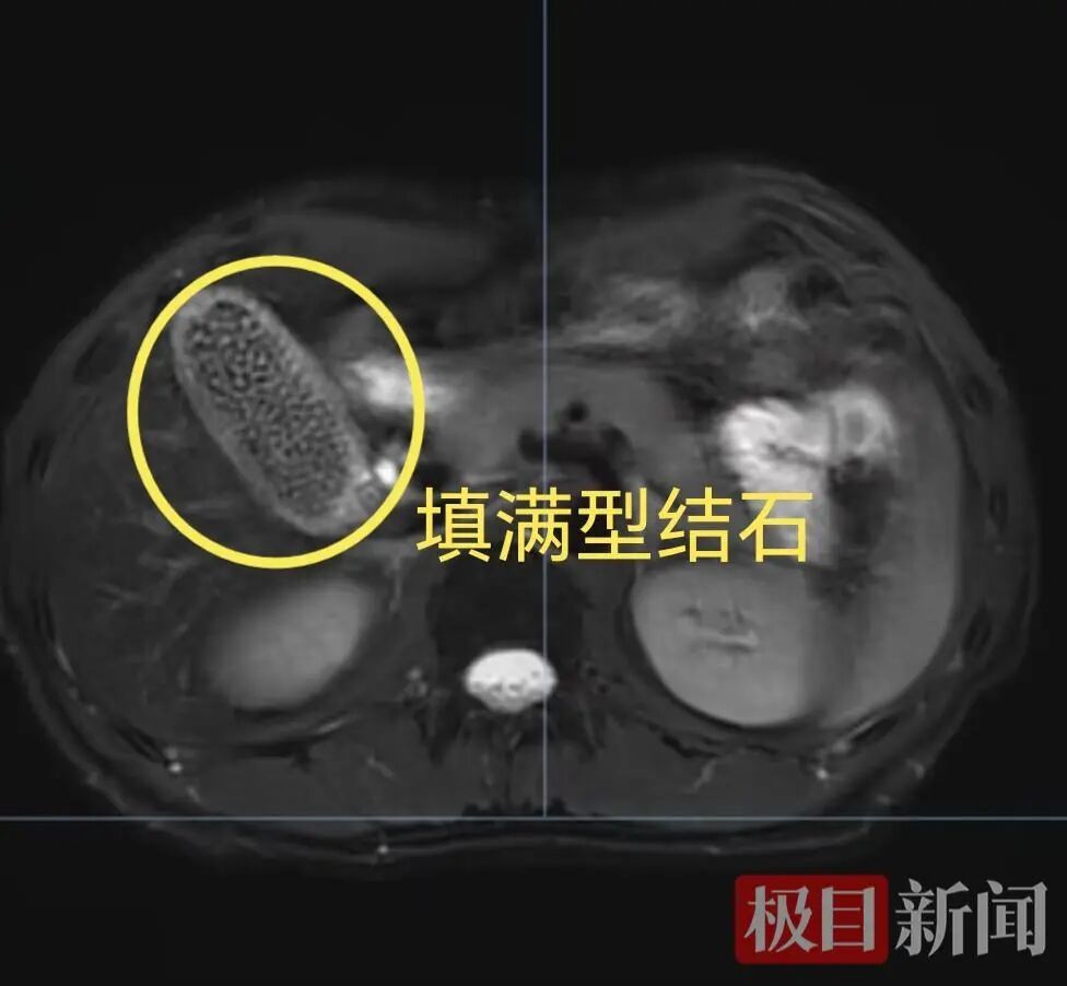 35岁男子胆囊被1000多颗结石塞满,医生提醒:切莫硬扛 35岁男子胆囊被1000多颗结石塞满,医生提醒:切莫硬扛