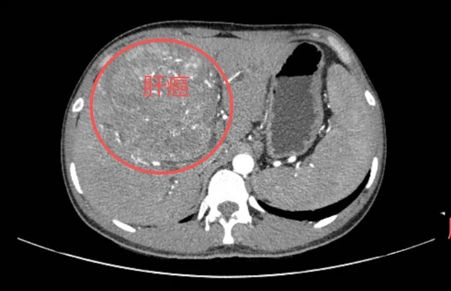 25岁查出肝癌晚期！这些误区正在悄悄“毁肝”