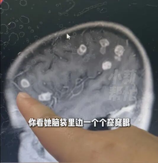 6岁女孩打扫卫生,大脑被侵蚀出20多个洞! 6岁女孩打扫卫生,大脑被侵蚀出20多个洞!