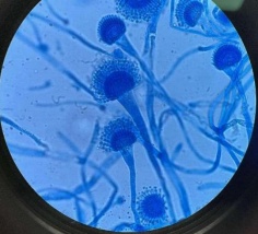 过年回家大扫除千万注意！有6岁女孩因此脑子被“啃”20多个洞