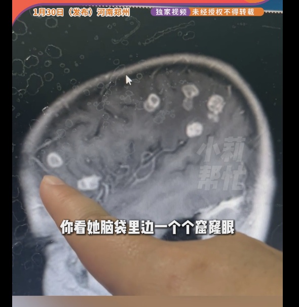 过年回家大扫除千万注意！有6岁女孩因此脑子被“啃”20多个洞