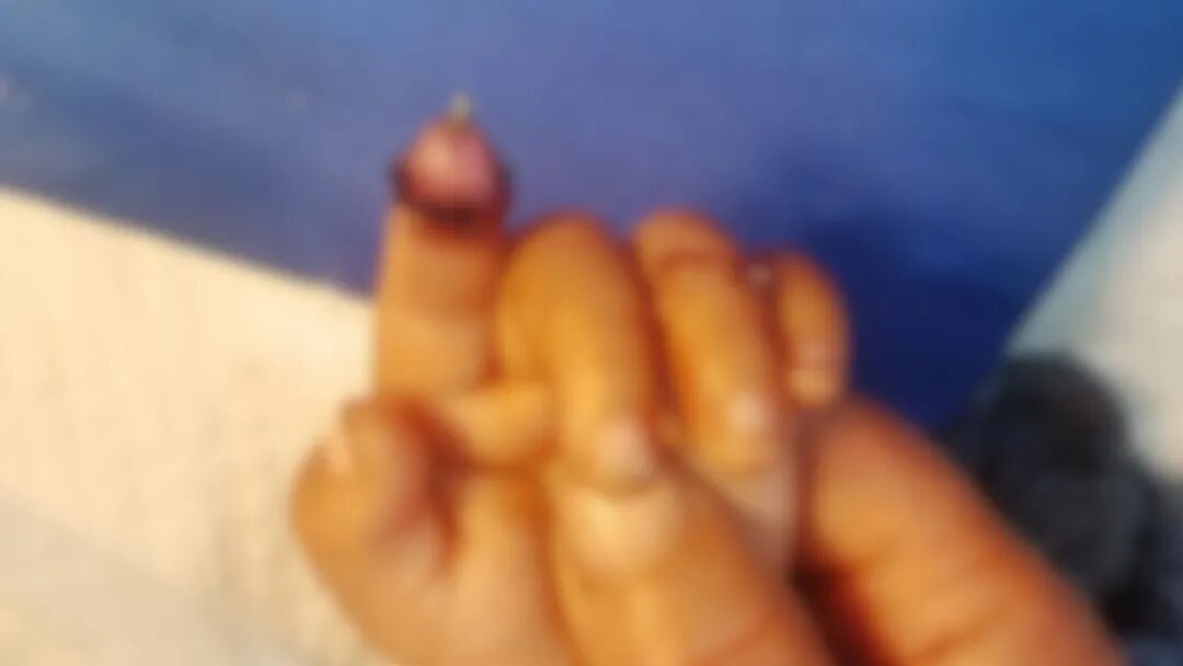 1岁男童被兔子咬断手指！家长为找断指将兔子开膛破肚…经及时救治断指已顺利成活