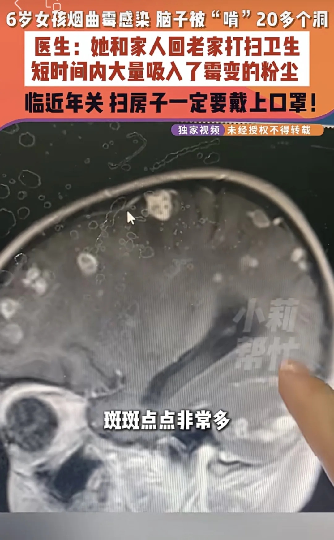 年前“大扫除”要警惕，这些清洁剂别“混搭”！6岁女孩发烧17天，医生紧急提醒...