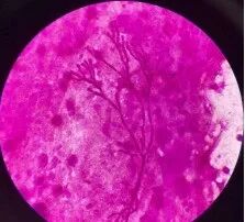 6岁女孩打扫卫生,大脑被侵蚀出20多个洞! 6岁女孩打扫卫生,大脑被侵蚀出20多个洞!