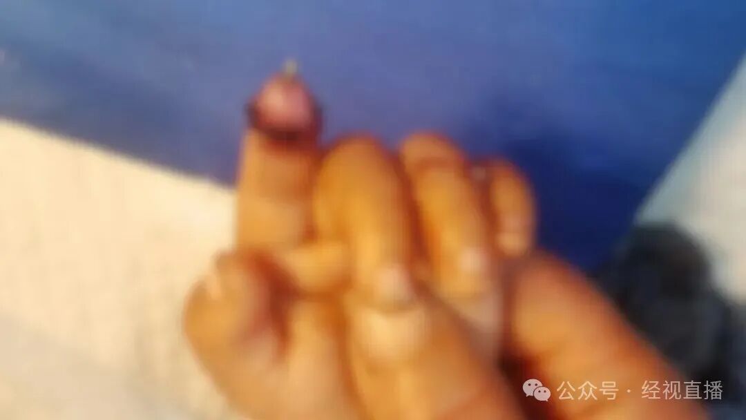 1岁幼童喂兔子被咬断手指,经及时救治断指已顺利成活 1岁幼童喂兔子被咬断手指,经及时救治断指已顺利成活