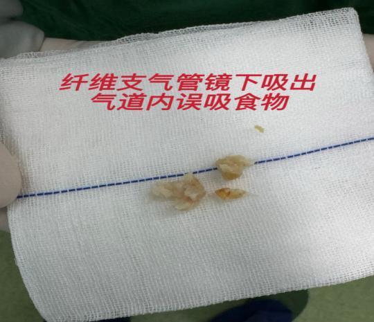 男子醉酒后气管被呕吐物完全堵塞,医生提醒不要让醉酒者仰卧 男子醉酒后气管被呕吐物完全堵塞,医生提醒不要让醉酒者仰卧