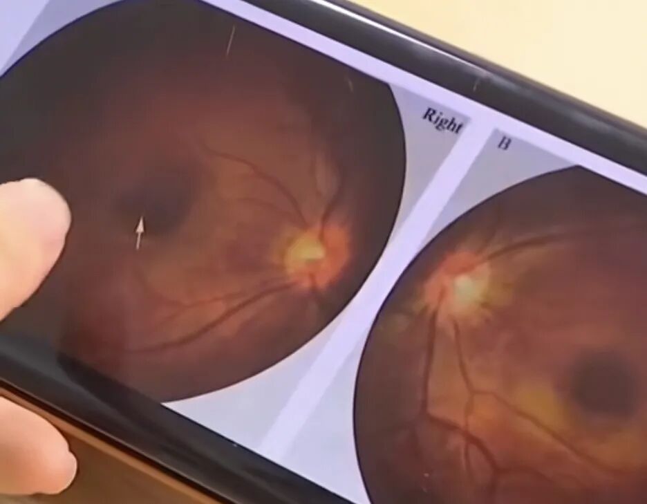 母亲连续多日使用致6个月婴儿终身弱视！很多人家里有，医生提醒