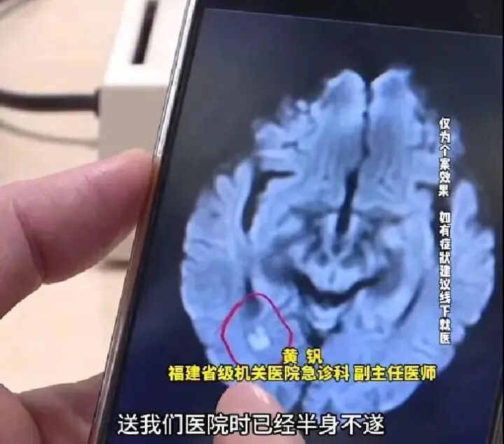 17岁高中生熬夜刷剧,突发脑梗半身不遂!和用“小太阳”有关? 17岁高中生熬夜刷剧,突发脑梗半身不遂!和用“小太阳”有关?