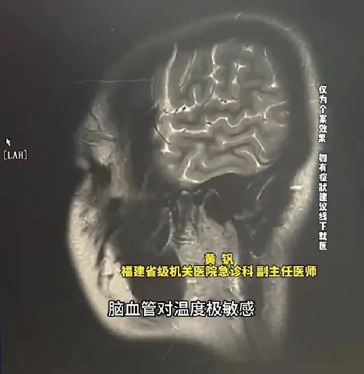 17岁高中生熬夜刷剧,突发脑梗半身不遂!和用“小太阳”有关? 17岁高中生熬夜刷剧,突发脑梗半身不遂!和用“小太阳”有关?