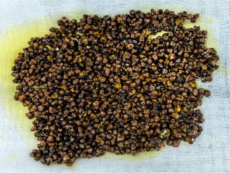 密密麻麻！厦门一位66岁阿姨体内取出700颗结石：“以为不痛不痒就没事”