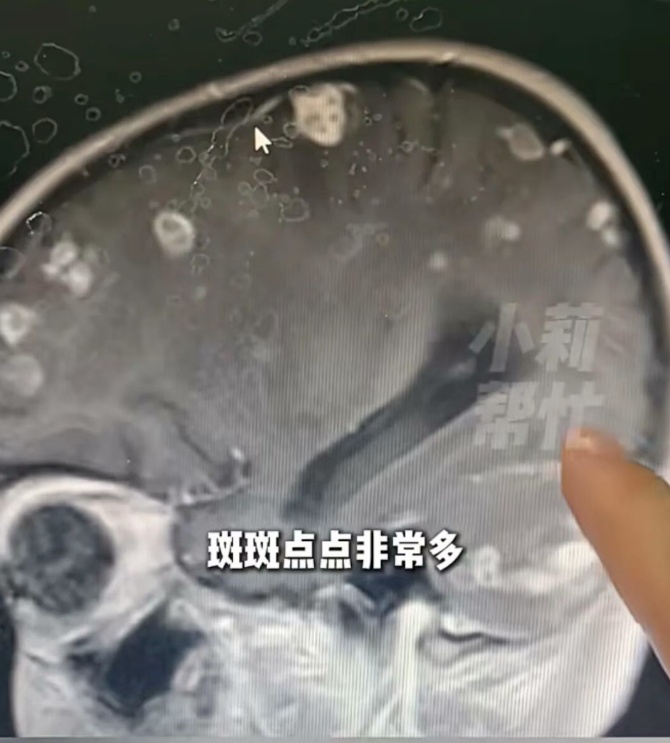 6岁女孩随家人大扫除感染烟曲霉，发烧17天，脑子被“啃”20多个洞