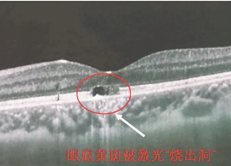 泉州8岁男童被激光笔照眼，视力骤降至0.2！医生：眼部外伤的儿童病例增多