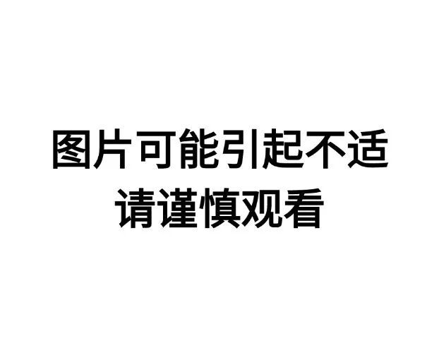 密密麻麻！厦门一位66岁阿姨体内取出700颗结石：“以为不痛不痒就没事”