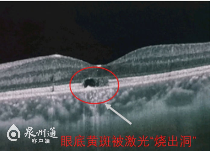 警惕！泉州8岁男童被激光笔照眼，视力骤降至0.2！医生提醒：别把激光笔当玩具！