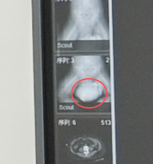 近11公斤重！如篮球般大小！福州一男子胯下长出肿物！医生：罕见！